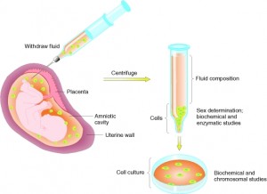 Diagnóstico prenatal- Amniocentesis