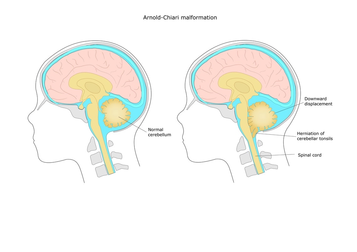 síndrome de chiari