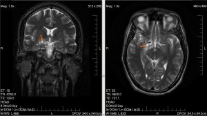 sintomas de tumor cerebral